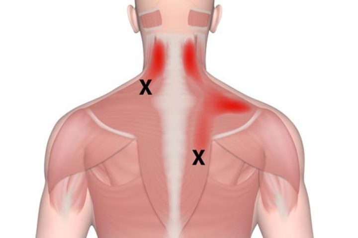 Dry-Needling-2 Dry-Needling-2