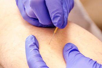 dry-needling Molenhoek Fysiotherapie Vaassen